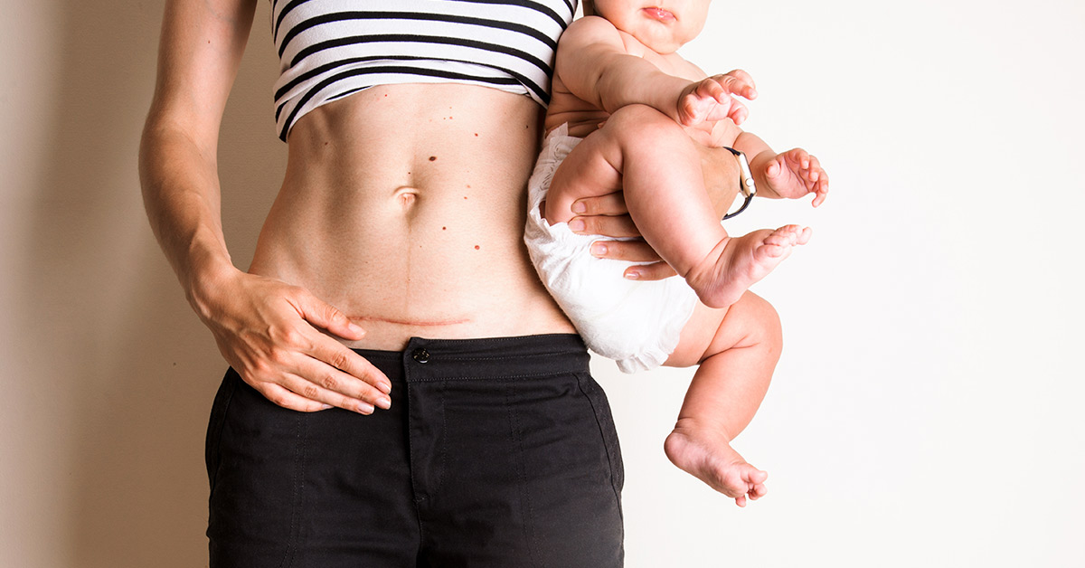 mom who had c-section holding child