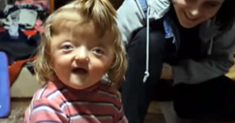 child with deformed skull