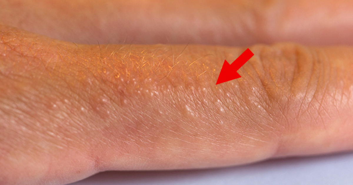 eczema
