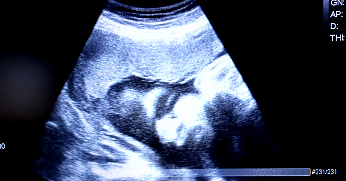 baby ultrasound