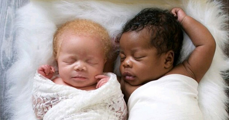 albino twins