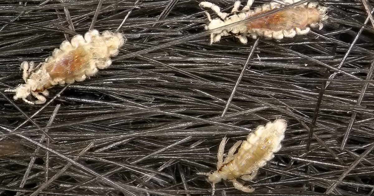 head lice