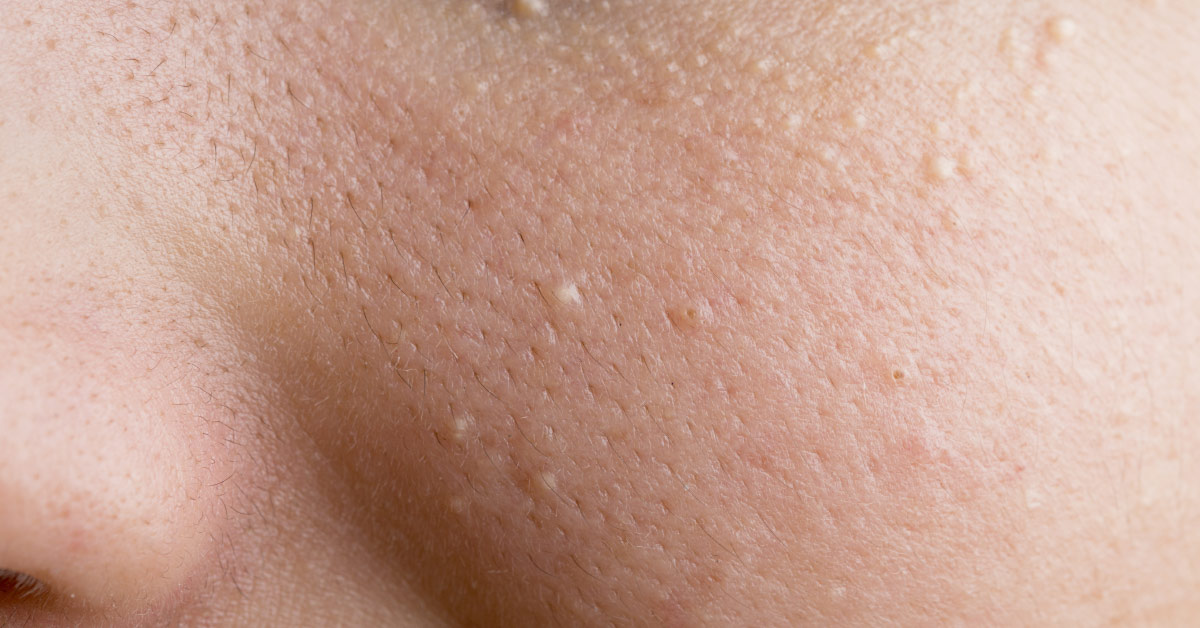 milia on a cheek
