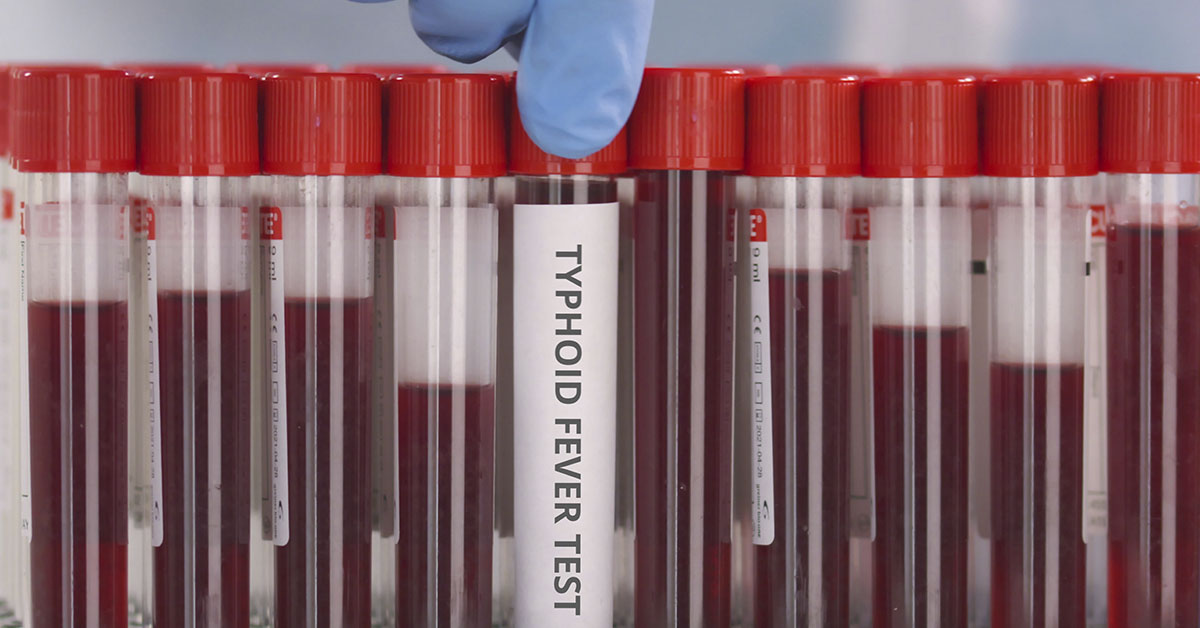 vials of blood, one labeled typhoid fever test