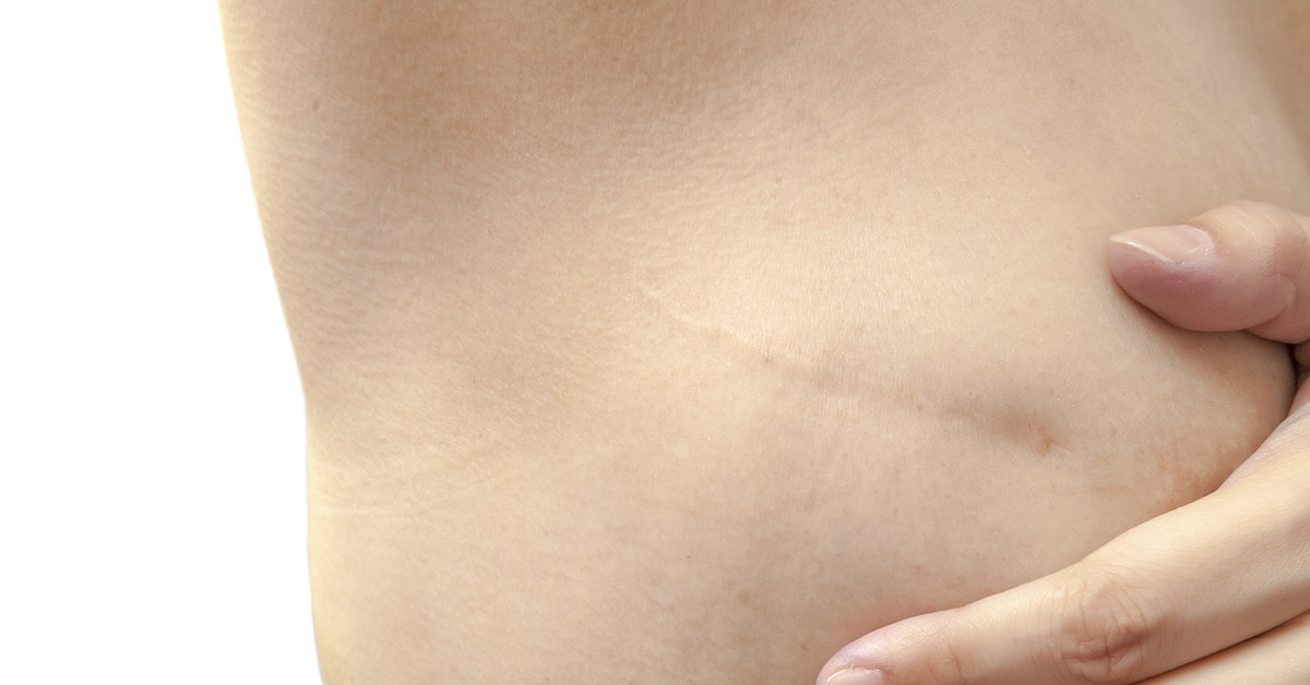 Mastectomy scar
