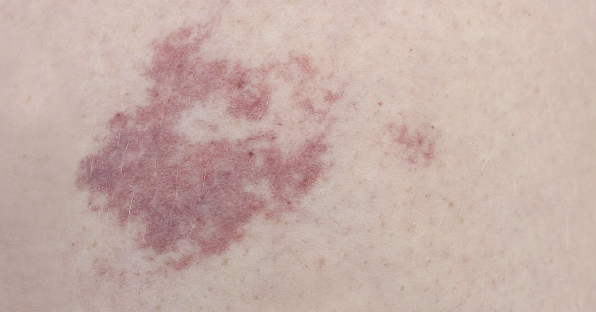 birthmark