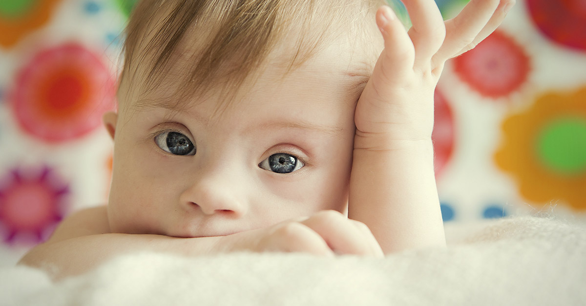baby with Down syndrome