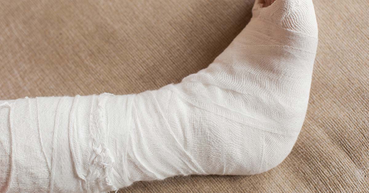 leg in cast