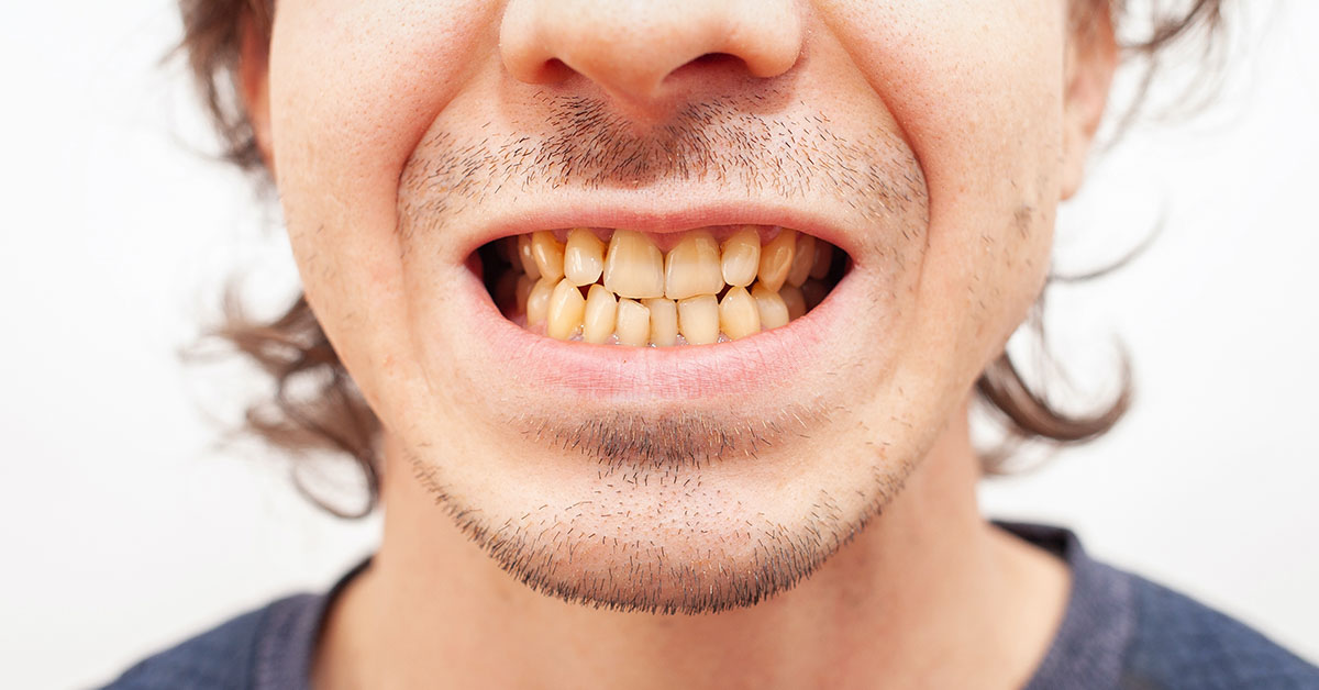 man with yellowing teeth