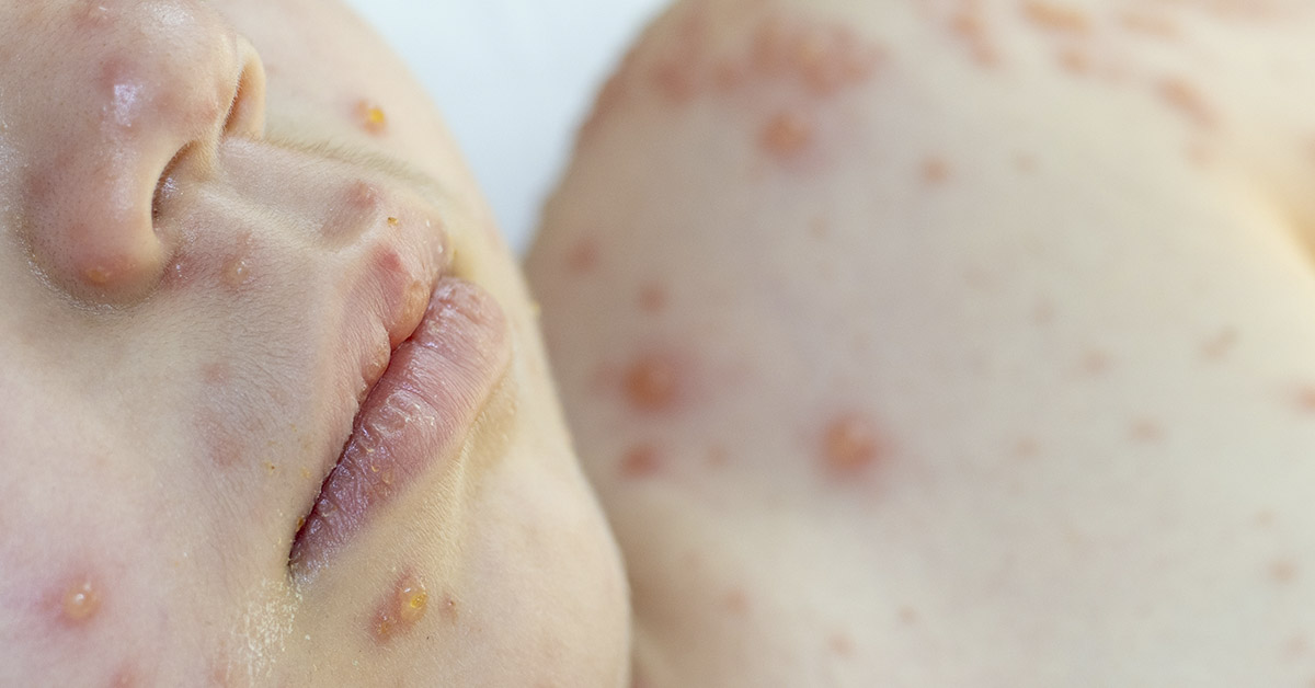 Baby with blister on lips and body