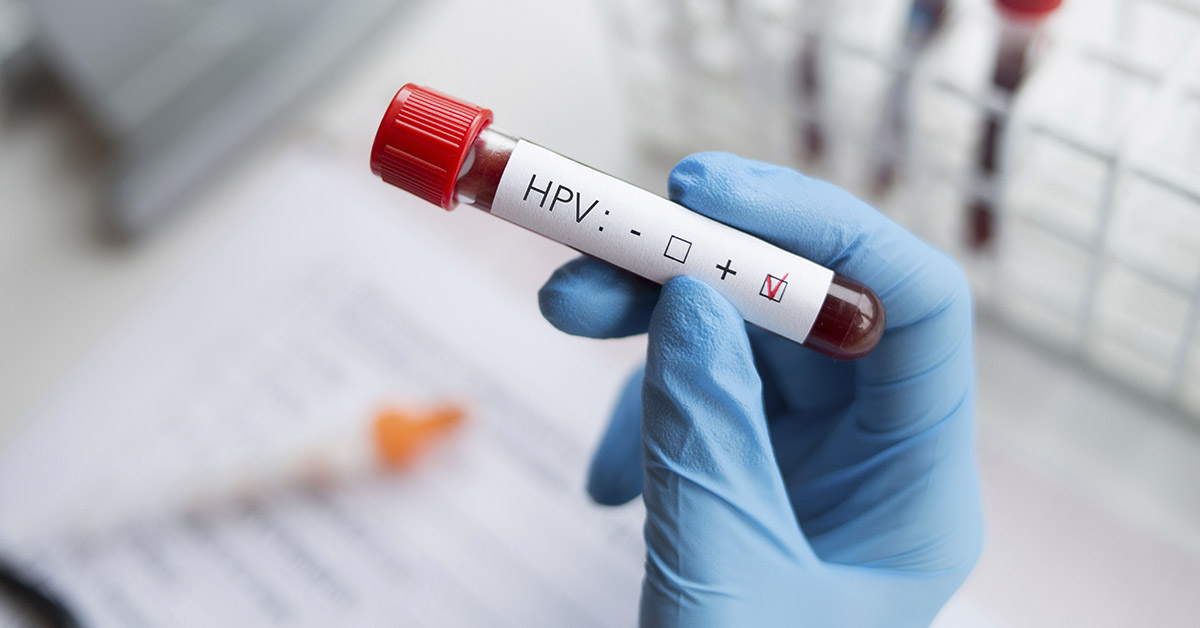 blood sample in vile labeled HPV test